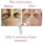 skin rejuvenation